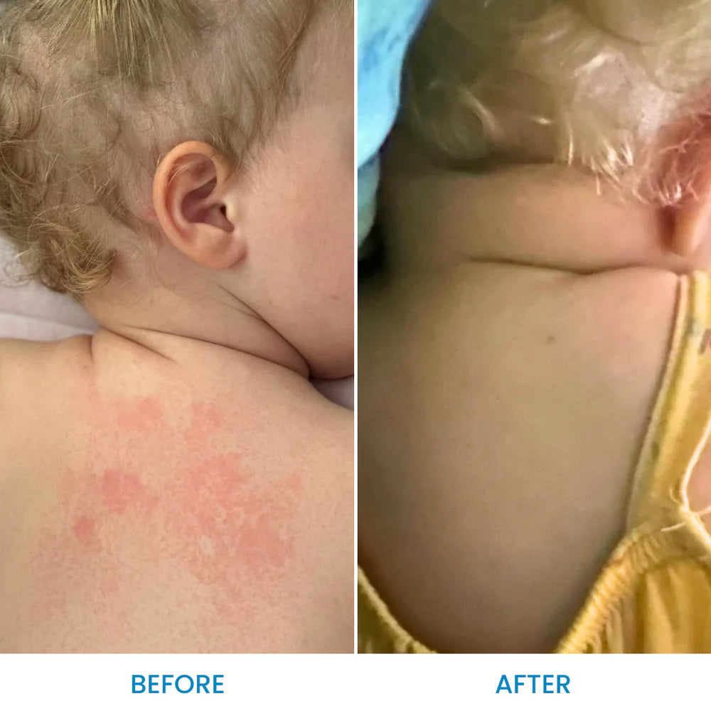 Baby Eczema Body and Bath Oil