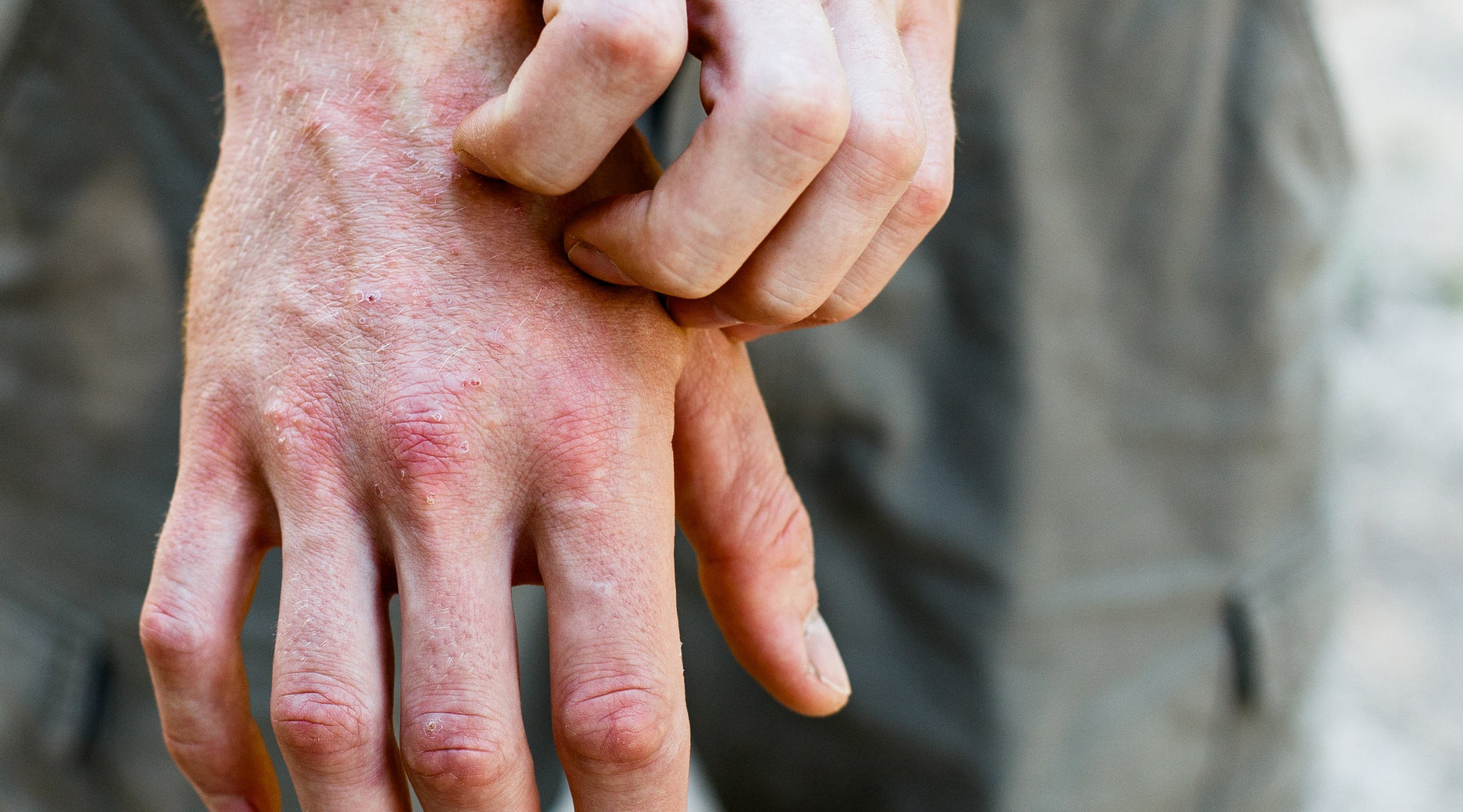 Managing Eczema Flare-Ups: To Do's & Not To Do's