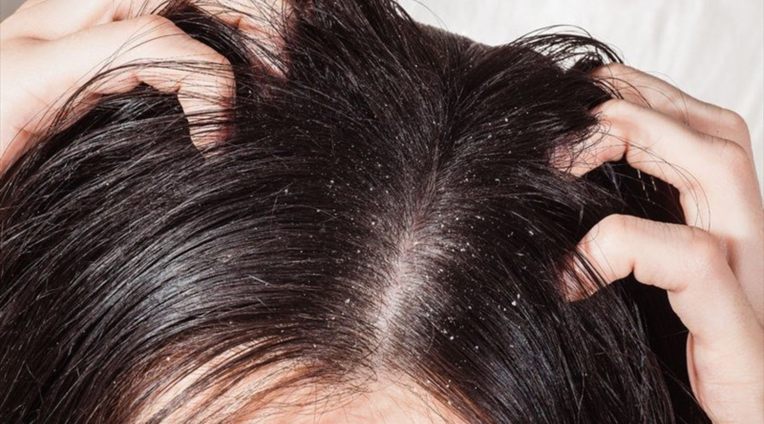 Do I Have Seborrheic Dermatitis or Dandruff