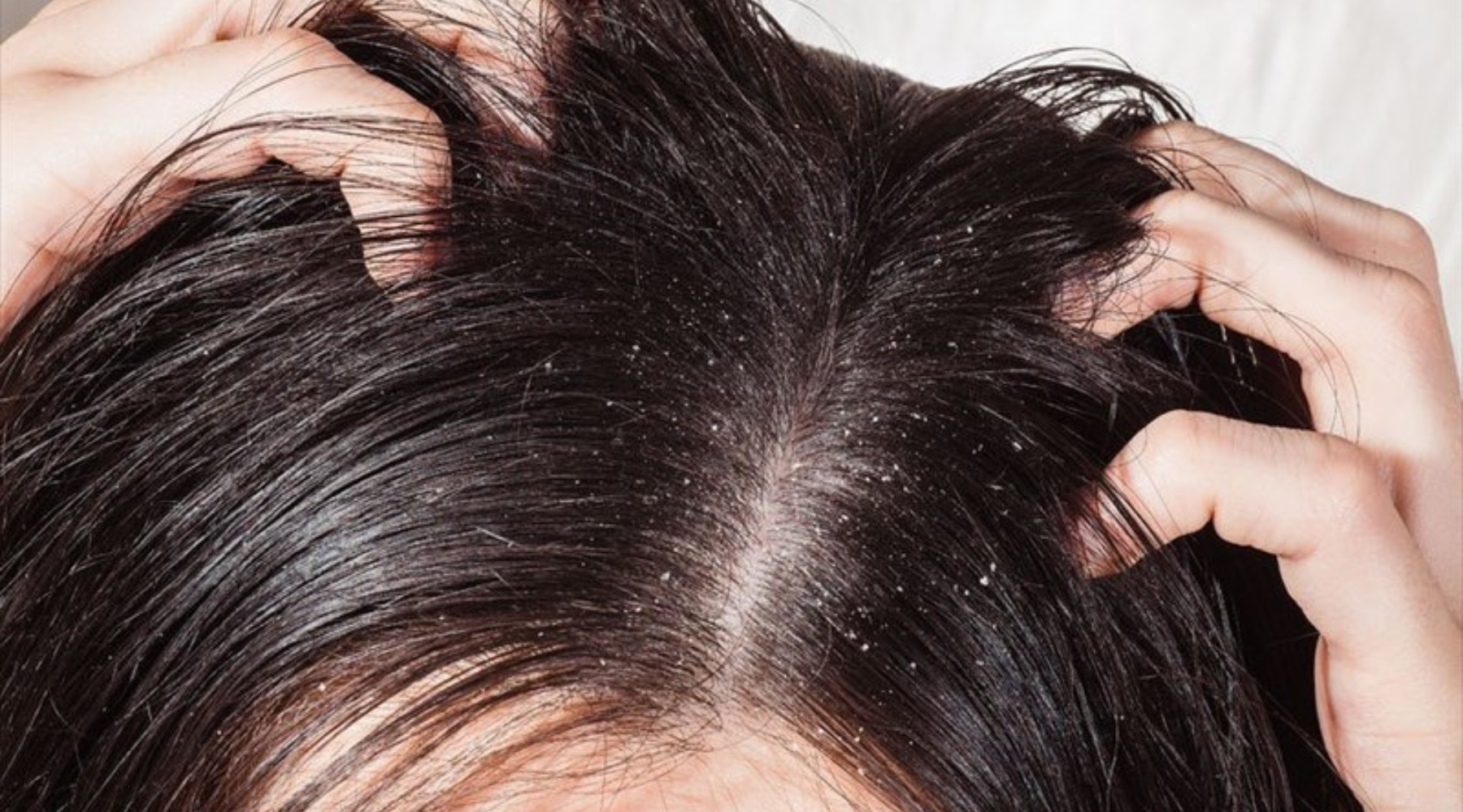 Do I Have Seborrheic Dermatitis or Dandruff