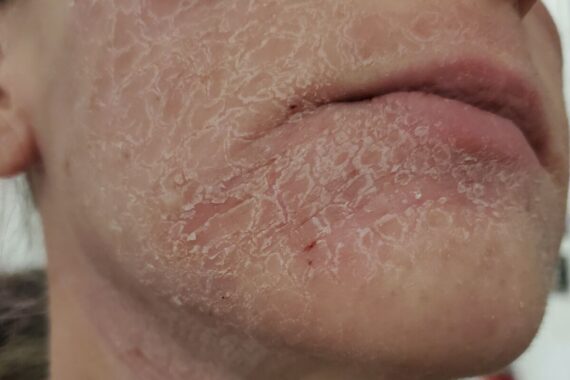 How To: Topical Steroid Withdrawal