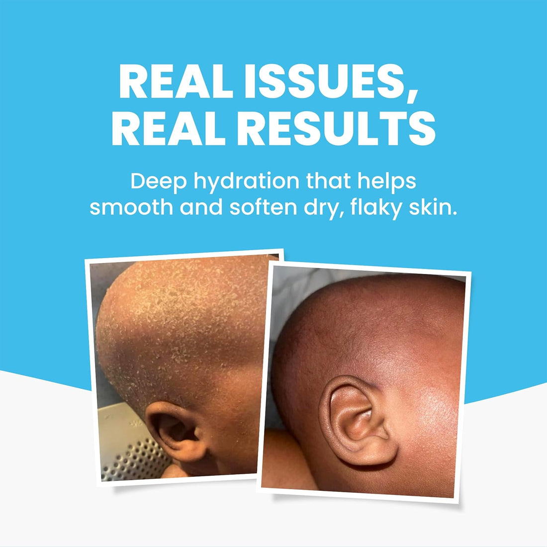 Baby Eczema Body and Bath Oil